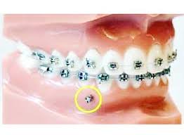 Ortodontist Dr Hatice Saracoglu Canakkale Mini Vidalar