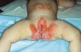 Image result for diaper dermatitis