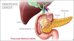 Pancreatic cancer does not always show symptoms, especially in the earlier stages. New Protocol For Pancreatic Cancer Discovered Thailand Medical News