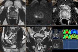 Whether you or someone you love has cancer, knowi. Case Presentation Intermediate Risk Prostate Cancer In A Fit 66 Year Old Man European Urology Focus