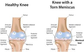 Research even shows that participating in physical therapy for a meniscus injury may help you avoid … Meniscal Tear Repair