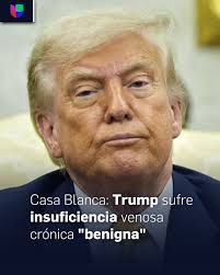 Donald Trump fue diagnosticado con insuficiencia venosa crónica tras notar  hinchazón leve en las piernas. La Casa Blanca informó que la afección es  benigna y común. ➡️ uni.vi/ZfvK106g7ns
