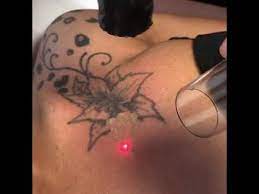 African American Woman Removes Chest Tattoo With Laser Youtube African Tattoo African American Tattoos Tattoos