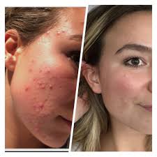 mondaymotivation by this beautiful babe Tanya 👑🤩💖 So many ladies ask me  how to get rid of cellulite.. well ladies this is Tanya's 3 month  transformation and just look at those legs🤩