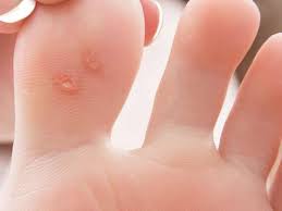 Warts which show up on the bottom or top of the feet or toes fall into the plantar wart category. 5 Effective Plantar Wart Treatment Prevention In Scottsdale