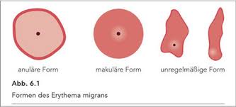694 likes · 25 talking about this. Lehrbuch Lyme Borreliose Praxis Berghoff