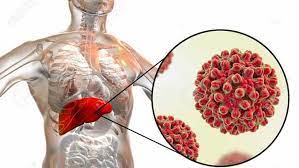 Liver detox diet adalah diet sederhana yang mengeliminasi racun dan mengandung. Hepatitis B Si Penyakit Kuning Yang Berisiko Menjadi Kanker Hati