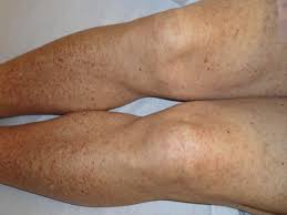 The term 'purpura' describes a purplish discolouration of the skin produced by small bleeding vessels near the surface. Henoch Schonlein Purpura In An Older Man Presenting As Rectal Bleeding And Iga Mesangioproliferative Glomerulonephritis A Case Report Journal Of Medical Case Reports Full Text