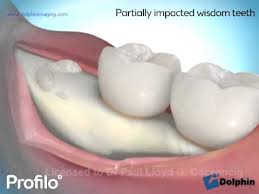 How wisdom teeth removal surgery recovers day to day in the following stages: Removing Impacted Wisdom Teeth Youtube