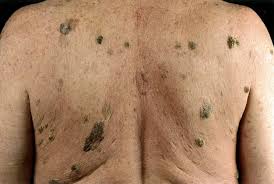 Lesions that are suspicious for malignancy, those with changing characteristics, symptomatic lesions, and those that family physicians should be able to distinguish potentially malignant from benign skin tumors. Benign Skin Lesions Amboss