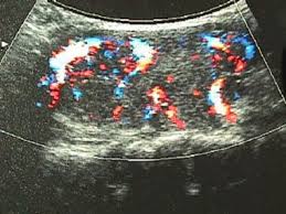 Thyroid cancers can also be categorized based on the doctors believe most thyroid cancers start as well differentiated. Hyperthyroidism And Thyrotoxicosis Practice Essentials Background Pathophysiology