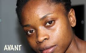 Astuce 100 Naturelle Pour Se Debarrasser Des Boutons Et Des Taches Sur Le Visage Ritini