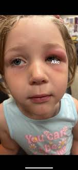 Tongue and lip revision for older children?