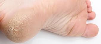 Dry Skin And Cracked Heels Podiatry Station Edgware