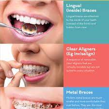 That being said, there are some general guidelines to keep in mind when considering whether. Types Of Braces Info Straighten Teeth Without Braces Teeth Straightening Straighten Teeth Without Braces Orthodontics Teeth