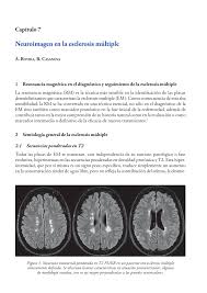 Forma ovoide y aparecen dispuestas perpendiculares al eje largo de los ventrículos en el. Pdf Neuroimagen En La Esclerosis Multiple