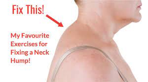A lump of fat on the back of your neck. Quick 4 Minute Fix For Neck Hump Youtube