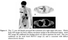 These imaging tests will show visual evidence of mesothelioma. Scielo Brasil Common Causes Of False Positive F18 Fdg Pet Ct Scans In Oncology Common Causes Of False Positive F18 Fdg Pet Ct Scans In Oncology