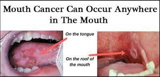 Signs and symptoms are ways the body lets you know that you have an injury, illness, or disease. How Can We Detect Oral Cancer Quora