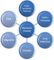 Meniere S Disease Risk Factors Welcomecure