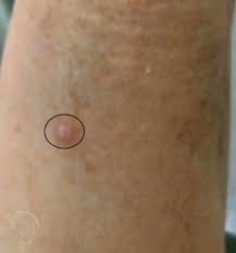 Mccs also spread aggressively through the blood vessels to many organs, particularly to liver, lung. Leiomyoma Of Arm Skin Cancer And Reconstructive Surgery Center