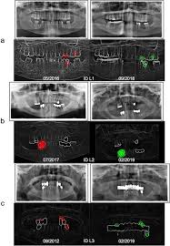 Then place the film in the styrofoam holder opposite the no. Automatic Human Identification Based On Dental X Ray Radiographs Using Computer Vision Scientific Reports