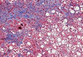 Image result for Fibrosis Probability Score