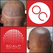 Ali safieddine leading the area for 7 years most successful procedure . Scalp Aesthetics Scalpaesthetics Profile Pinterest