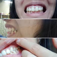 Thus usually includes extraction and reshaping the lower teeth through veneers. Byefeefee