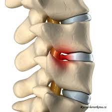 Image result for vyhřezlá ploténka