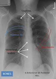 Because some conditions of the chest. Chest X Ray Interpretation Structured Simple Clear