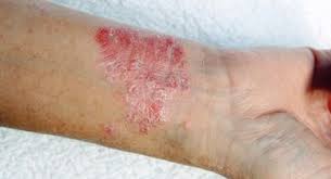 Image result for scabies on humans