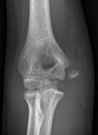 Medial epicondyle apophysitis, often called little league elbow, is the most common injury affecting young baseball pitchers whose bones have not yet stopped growing. Medial Epicondyle Avulsion Fracture Radiology Case Radiopaedia Org