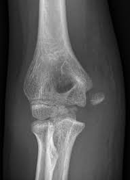 The lcl attaches to the lateral femoral epicondyle, proximal to the popliteal groove, from where it runs to the head of the fibula anterior to its apex. Medial Epicondyle Avulsion Fracture Radiology Case Radiopaedia Org