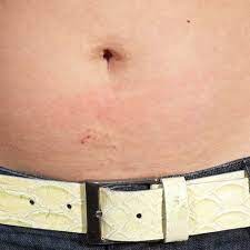 Mild Allergic Nickel Dermatitis Caused By Nickel Release From A Belt Download Scientific Diagram