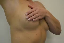 Image result for Intertrigo under breasts