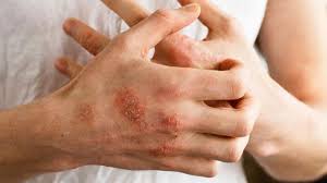 Ia dikenali juga sebagai atopic dermatitis (kulit). Apa Itu Ekzema Apakah Punca Dan Gejala Ekzema Diagnosis Dan Rawatan Ekzema