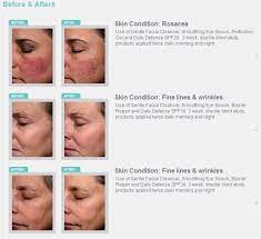 Is exuviance a good product? Important Things To Know Before Having A Chemical Peel Wembley Clinic