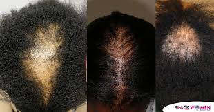 Here are 22 things you can try to stop hair loss now and prevent more hair loss in the it's when hair loss is persistent that you want to see your doctor. Hair Growth Hairstyle For Black Women