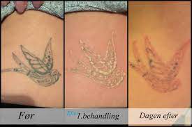 Se med når det passer dig. Tatoveringsfjernelse I Horsens Effektiv Fjernelse Af Tattoos Removeit Dk