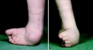 It affects the bones, muscles, tendons and blood vessels and can affect one or both feet. The Clubfoot Congenital Talipes Equinovarus Springerlink