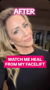 Comment LIFT if you want to see the full journey and everything I shared  about my facelift , I am now 2 months post-facelift and everyday I’m  happier with the results!, I shared everything because I ...