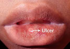 pin on autoimmune disorder