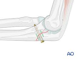Olecranon (plural olecranons or olecrana). Ulna Articular Olecranon Simple Plate With Or Without Lag Screw