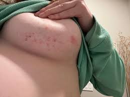 Image result for heat rash under breasts