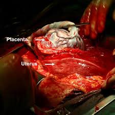 Operative Findings During Caesarean Section Note Placenta Previa Download Scientific Diagram