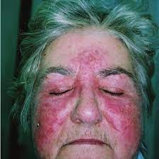 Recently, md has been reported to be associated with the infiltration of mast cells. Differential Diagnoses Of Morbihan Syndrome Download Scientific Diagram