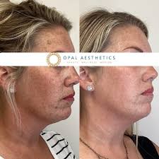 Crystal Sponamore BSN, RN (@crystal_injects) • Instagram photos and videos