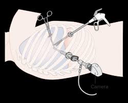 En cas d'épanchement pleural dû à la présence de cellules tumorales dans la cavité pleurale, on vide cet épanchement puis on insuffle du. Pleuresie Thoracoscopie Chirurgie Thoracique Hopital Bichat