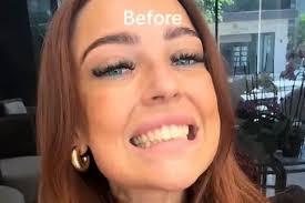 I got Turkey teeth that will last 10 years